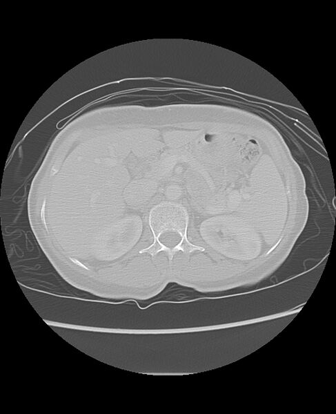 File:Chondrosarcoma (Radiopaedia 79427-92532 Axial lung window 59).jpg
