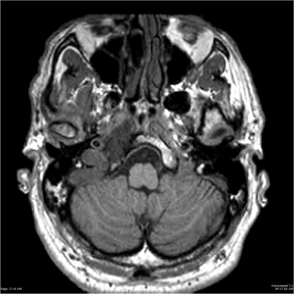 File:Chondrosarcoma of skull base- grade II (Radiopaedia 40948-43654 Axial T1 17).jpg