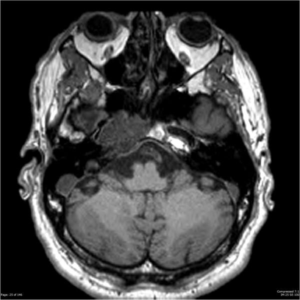 File:Chondrosarcoma of skull base- grade II (Radiopaedia 40948-43654 Axial T1 25).jpg