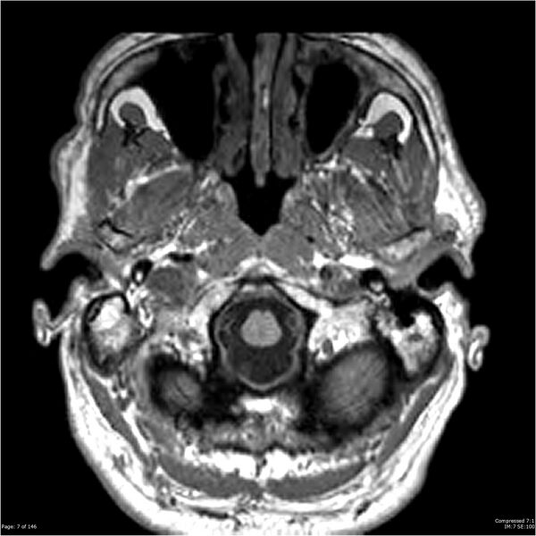 File:Chondrosarcoma of skull base- grade II (Radiopaedia 40948-43654 Axial T1 7).jpg