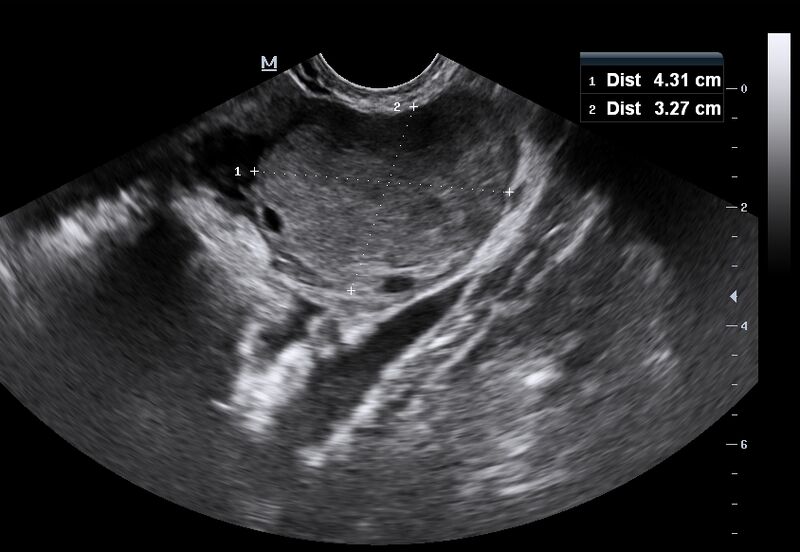 File:Choriocarcinoma of ovary with cerebral and pulmonary metastases (Radiopaedia 25983-26117 Oblique 1).JPG