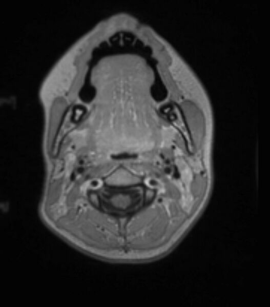 File:Choroid plexus carcinoma (Radiopaedia 91013-108553 Axial T1 C+ 41).jpg