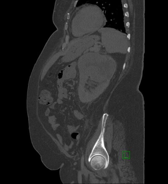 File:Chromophobe renal cell carcinoma (Radiopaedia 84239-99519 Sagittal bone window 29).jpg