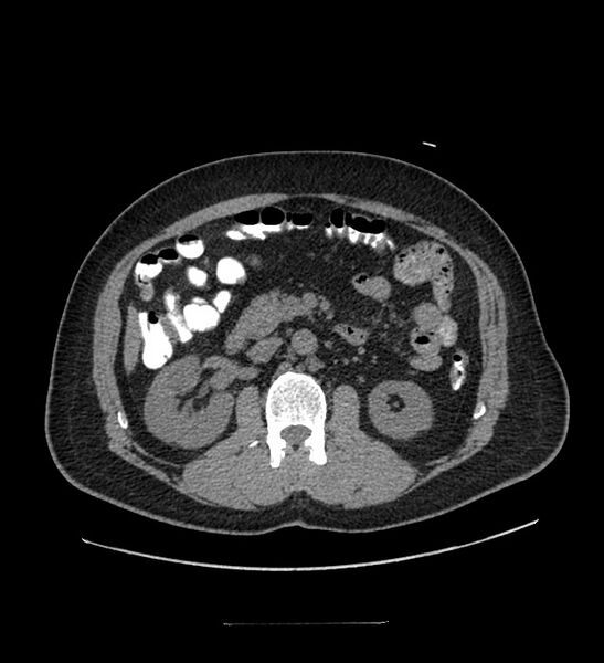 File:Chromophobe renal cell carcinoma (Radiopaedia 84337-99644 Axial non-contrast 44).jpg