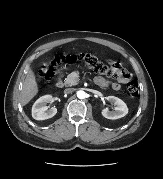 File:Chromophobe renal cell carcinoma (Radiopaedia 86879-103083 B 54).jpg