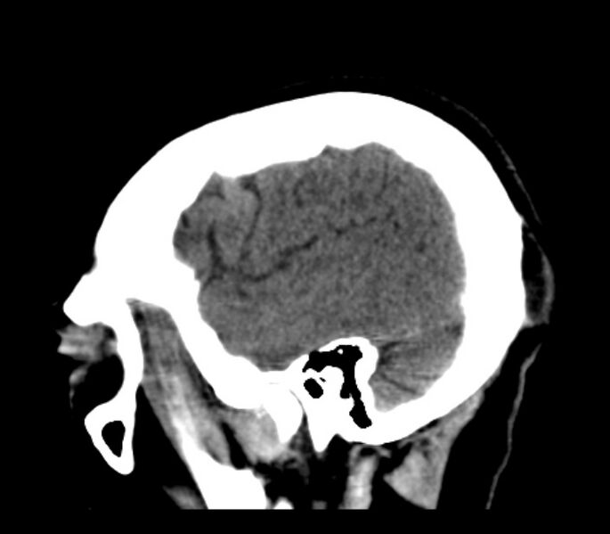 File:Chronic bilateral occipital lobe infarcts (Radiopaedia 31276-31996 C 33).jpg
