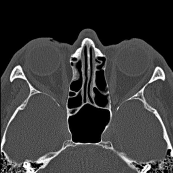 File:Chronic maxillary sinusitis (Radiopaedia 27879-28116 Axial bone window 34).jpg