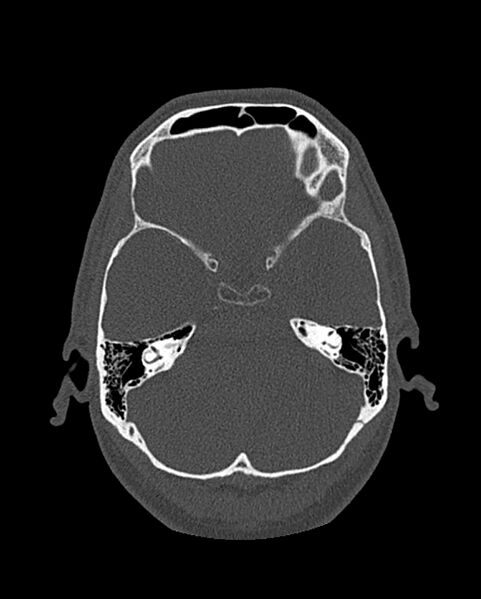 File:Chronic maxillary sinusitis caused by a foreign body (Radiopaedia 58521-65676 Axial bone window 266).jpg