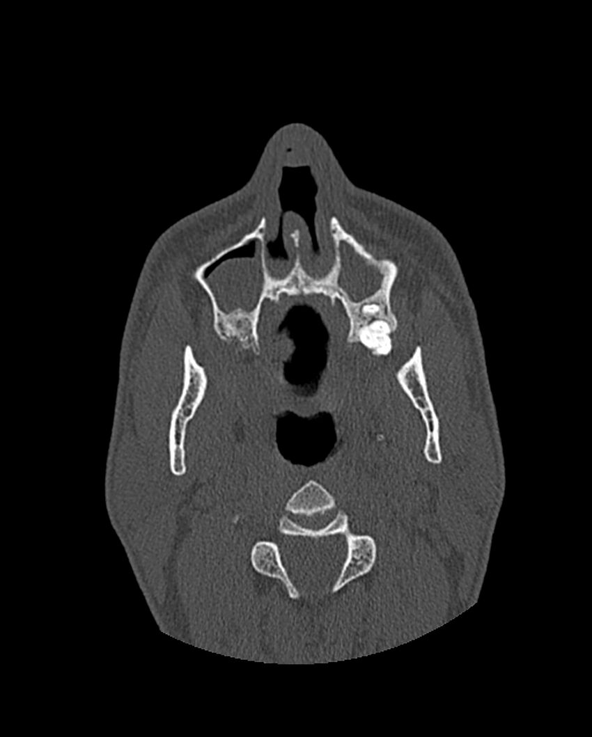 Chronic maxillary sinusitis caused by a foreign body (Radiopaedia 58521-65676 Axial bone window 63).jpg