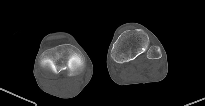 File:Chronic osteomyelitis (with sequestrum) (Radiopaedia 74813-85822 Axial non-contrast 198).jpg