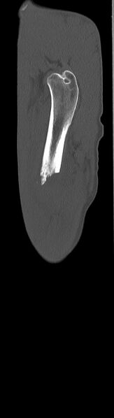 File:Chronic osteomyelitis (with sequestrum) (Radiopaedia 74813-85822 C 99).jpg