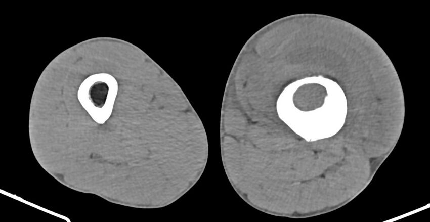 Chronic osteomyelitis (with sequestrum) (Radiopaedia 74813-85822 D 112).jpg