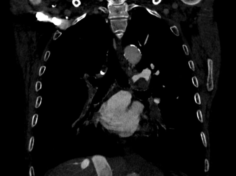 File:Chronic pulmonary embolism (Radiopaedia 91241-108843 A 61).jpg