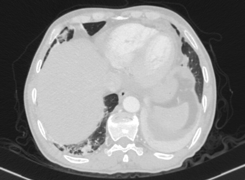 File:Chronic pulmonary embolism with bubbly consolidation (Radiopaedia 91248-108850 Axial lung window 128).jpg