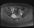 Class II Mullerian duct anomaly- unicornuate uterus with rudimentary horn and non-communicating cavity (Radiopaedia 39441-41755 Axial T1 fat sat 54).jpg