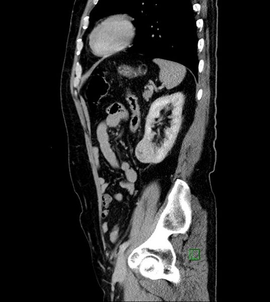File:Clear cell renal cell carcinoma (Radiopaedia 85006-100539 G 17).jpg