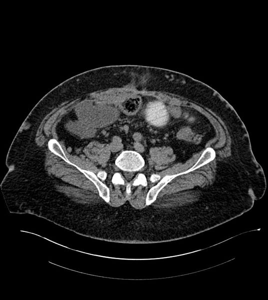 File:Closed-loop small bowel obstruction-internal hernia (Radiopaedia 78439-91096 Axial non-contrast 110).jpg