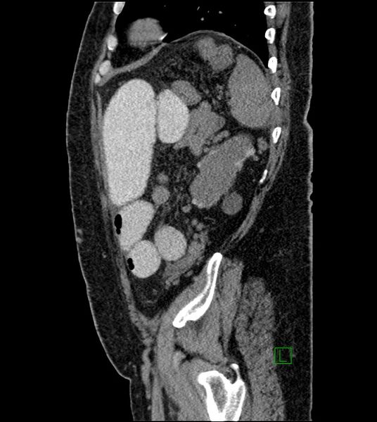 File:Closed-loop small bowel obstruction-internal hernia (Radiopaedia 78439-91096 C 39).jpg