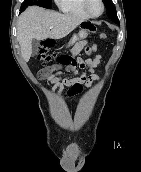 File:Closed loop small bowel obstruction - internal hernia (Radiopaedia 57806-64778 A 26).jpg