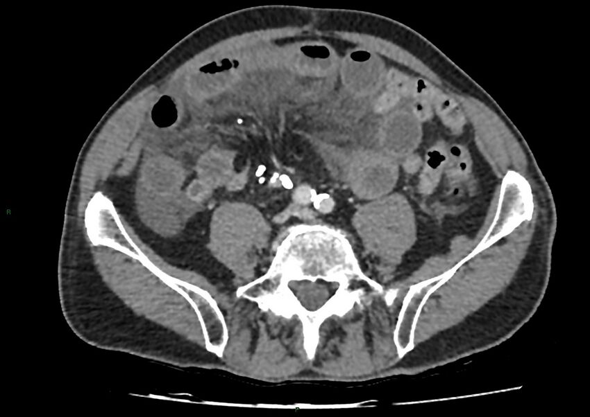 Closed loop small bowel obstruction with ischemia (Radiopaedia 84180-99456 A 78).jpg