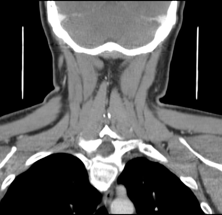 Colloid cyst of thyroid (Radiopaedia 22897-22923 Coronal C+ delayed 48).jpg