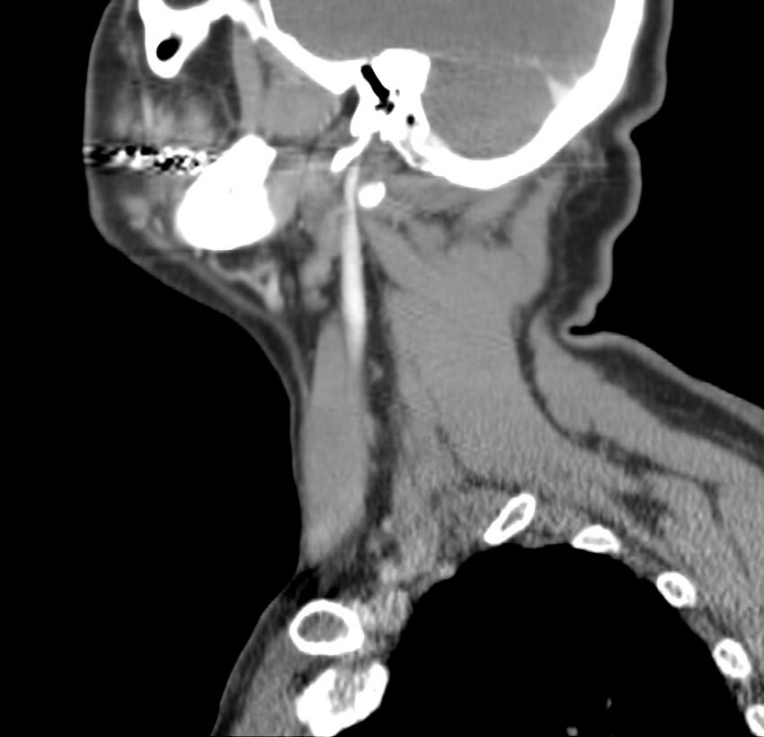 Colloid cyst of thyroid (Radiopaedia 22897-22923 Sagittal C+ delayed 44).jpg