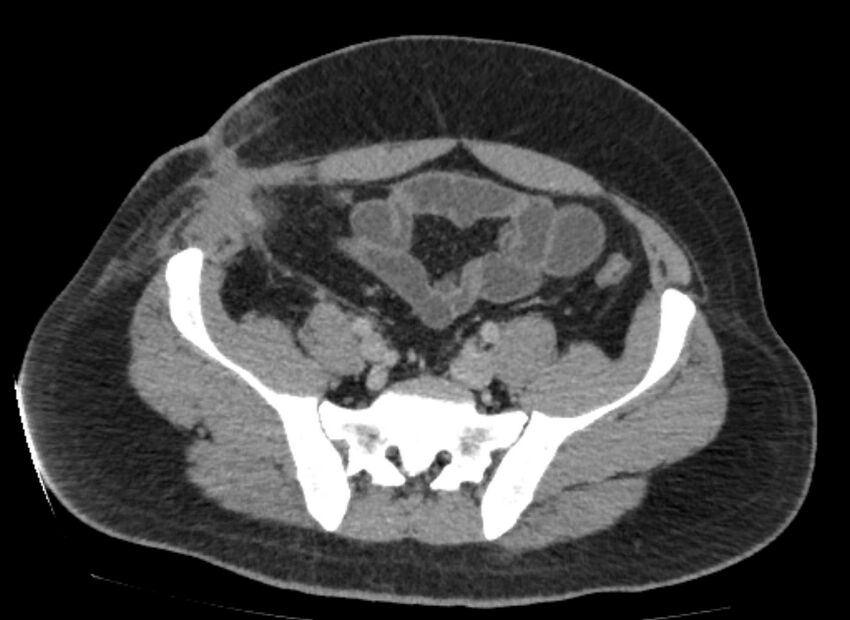 Colocutaneous fistula (Radiopaedia 56401-63062 A 70).jpg