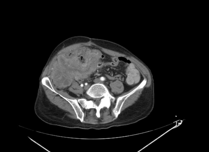 File:Colon cancer mimicking renal cell carcinoma (Radiopaedia 28986-29335 B 53).jpg