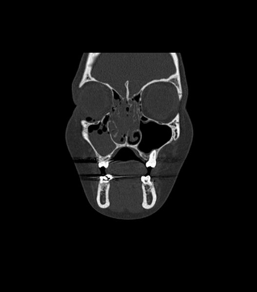 File:Nasoorbitoethmoid fracture (Radiopaedia 90044-107205 Coronal bone window 40).jpg