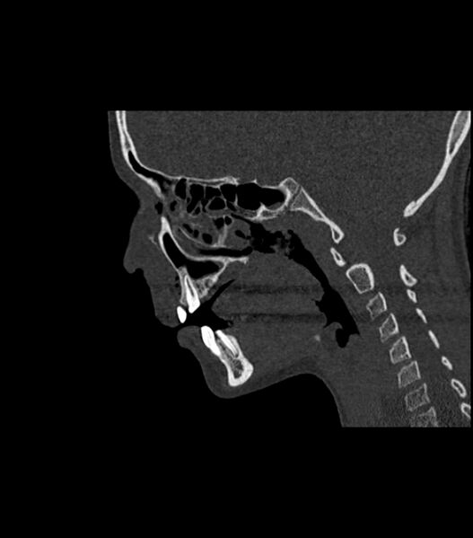 File:Nasoorbitoethmoid fracture (Radiopaedia 90044-107205 Sagittal bone window 64).jpg