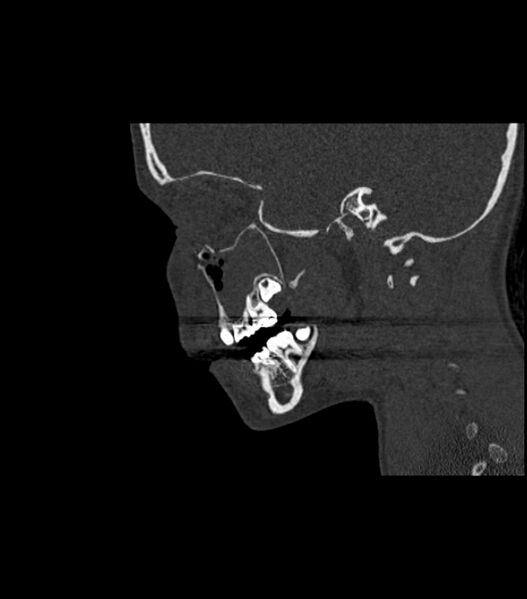File:Nasoorbitoethmoid fracture (Radiopaedia 90044-107205 Sagittal bone window 97).jpg