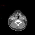 Nasopharyngeal lymphoma (Radiopaedia 54235-60433 A 11).jpg