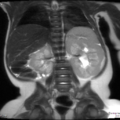 Nephroblastomatosis (Radiopaedia 39984-42477 Coronal T2 1).png