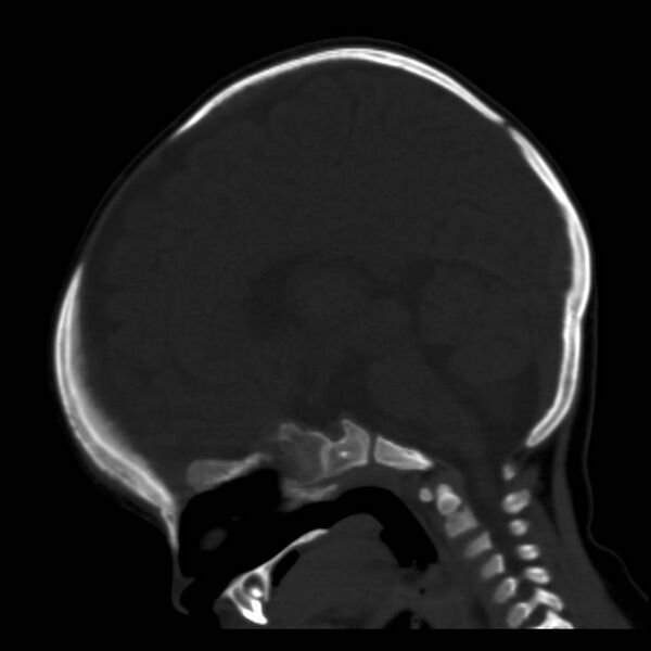 File:Neuroblastoma with skull metastases (Radiopaedia 30326-30958 Sagittal bone window 21).jpg