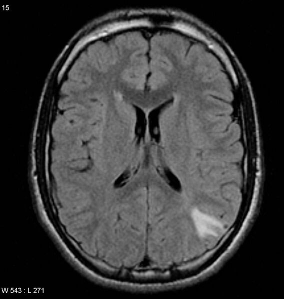 File:Neurocysticercosis (Radiopaedia 4767-6773 Axial FLAIR 1).jpg