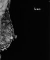 Neurofibromatosis of the breast (Radiopaedia 49024-54114 B 1).jpeg