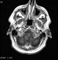 Neurosarcoidosis (Radiopaedia 10930-17204 Axial T1 C+ 1).jpg