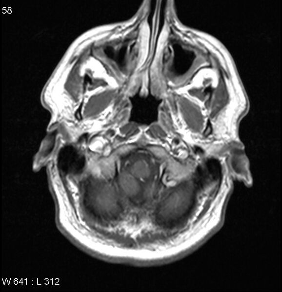 File:Neurosarcoidosis (Radiopaedia 10930-17204 Axial T1 C+ 1).jpg