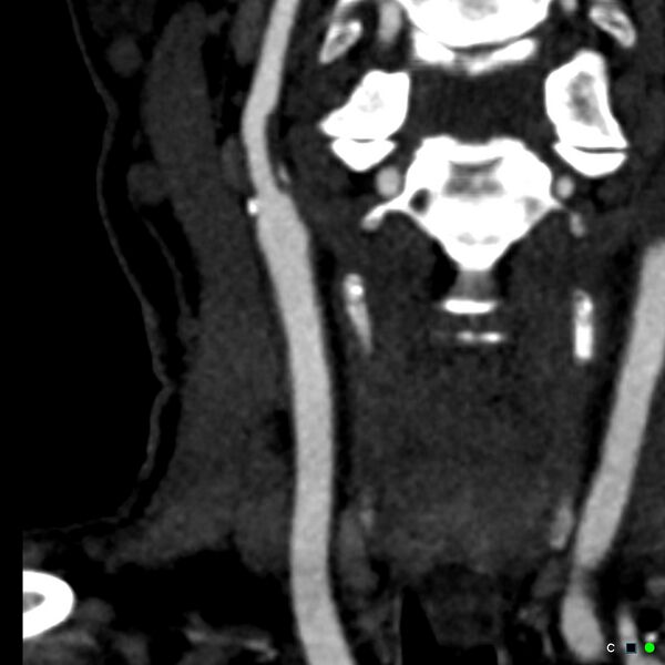 File:Non-occlusive intraluminal internal carotid artery thrombus (Radiopaedia 37751-39658 C 37).jpg