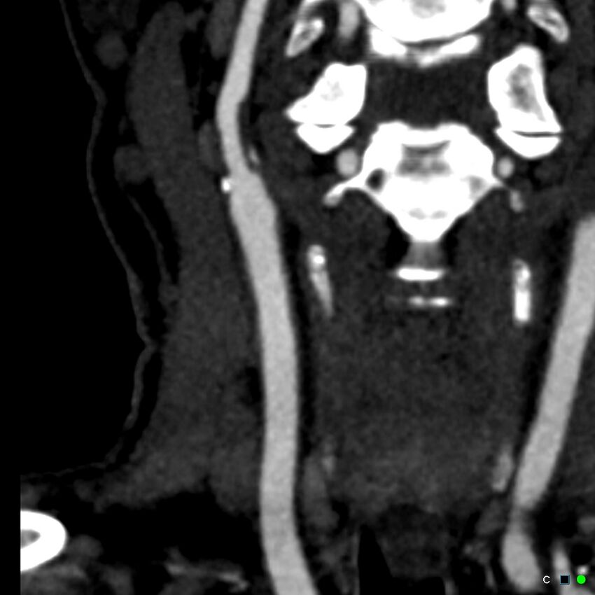 Non-occlusive intraluminal internal carotid artery thrombus (Radiopaedia 37751-39658 C 37).jpg