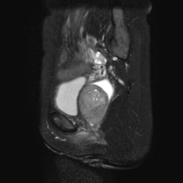 File:Non-puerperal uterine inversion (Radiopaedia 78343-90983 Sagittal T2 fat sat 18).jpg