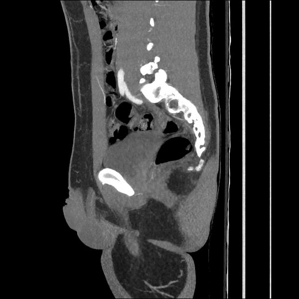 File:Normal CT angiogram of pelvis (Radiopaedia 45390-49430 C 41).jpg