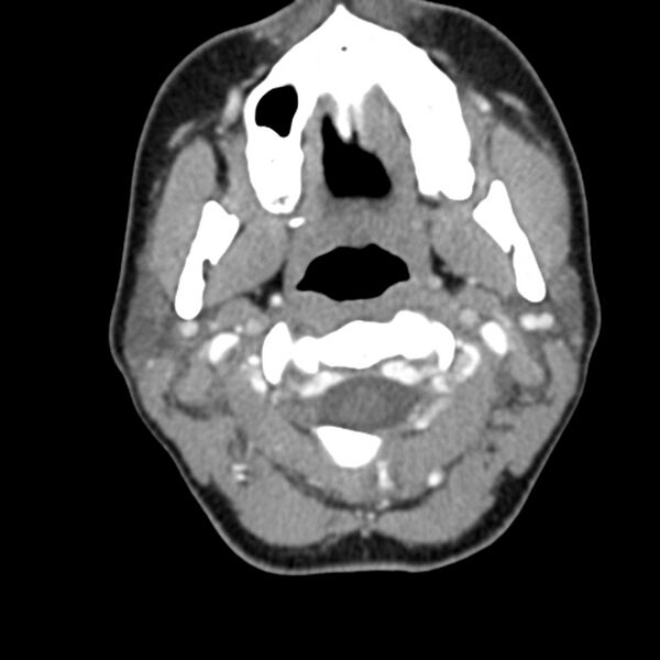 File:Normal CT of the neck (Radiopaedia 14575-14500 Axial C+ 24).jpg