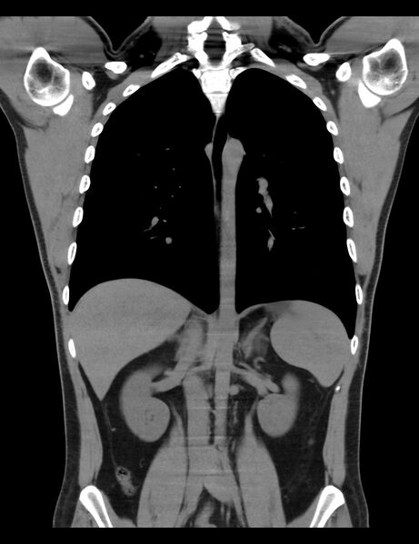 File:Normal CT virtual gastroscopy (Radiopaedia 29960-30501 E 2).jpg