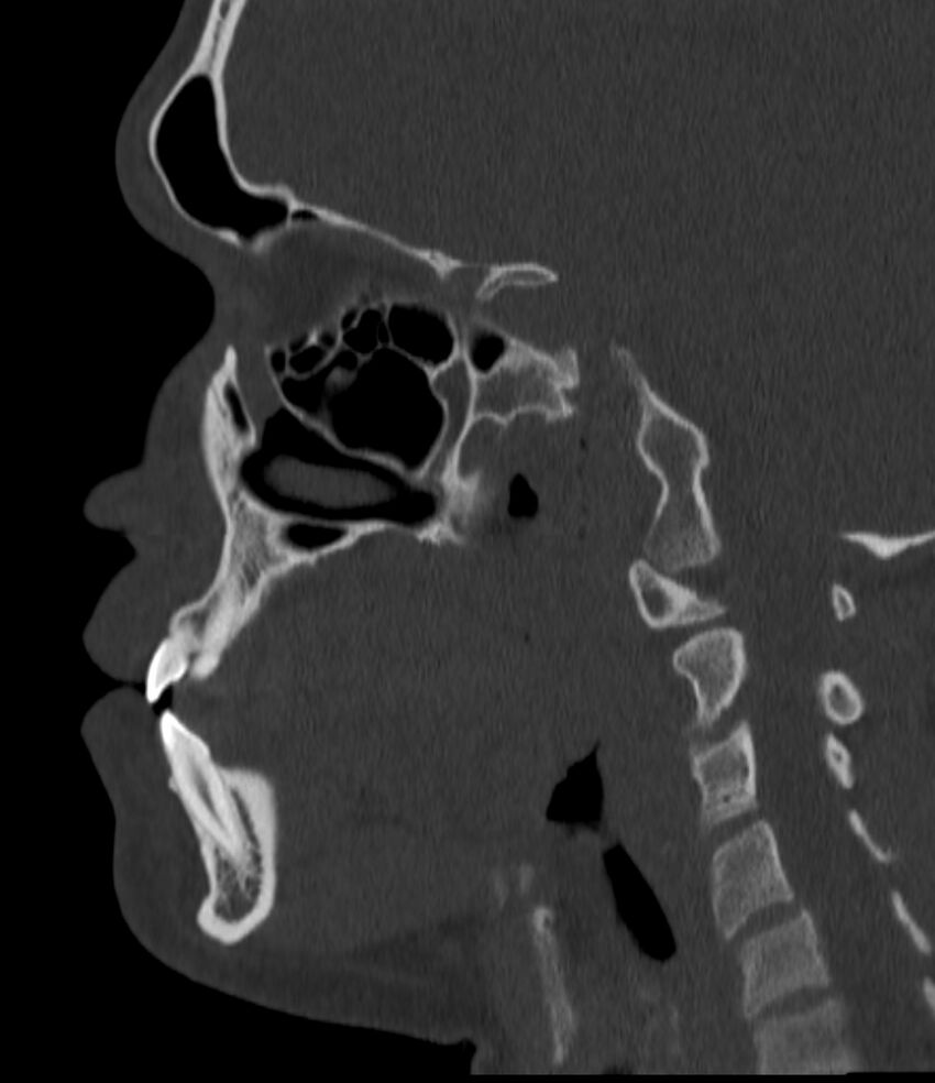Normal facial bone CT (Radiopaedia 88742-105476 Sagittal bone window 99).jpg