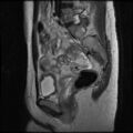 Normal female pelvis MRI (retroverted uterus) (Radiopaedia 61832-69933 Sagittal T2 13).jpg