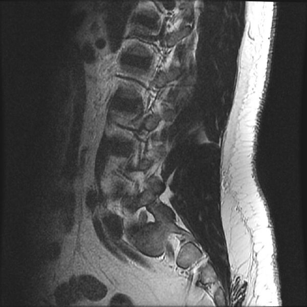 File:Normal lumbar spine MRI (Radiopaedia 43051-46311 Sagittal T2 5).jpg