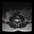 Normal spine MRI (Radiopaedia 77323-89408 Axial T2 6).jpg
