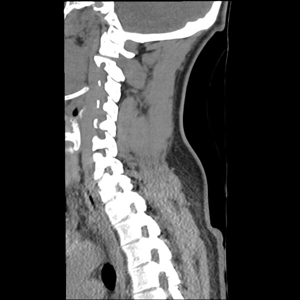 File:Normal trauma spine imaging (Radiopaedia 31753-32686 A 28).jpg