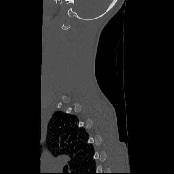 File:Normal trauma spine imaging (age 16) (Radiopaedia 45335-49358 Sagittal bone window 3).jpg